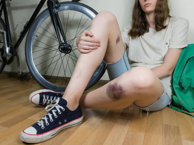 Kā veiksmīgi tikt galā ar nelielām traumām?
