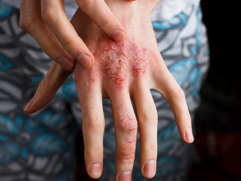 Neuzveicamā cīņa ar atopisko dermatītu