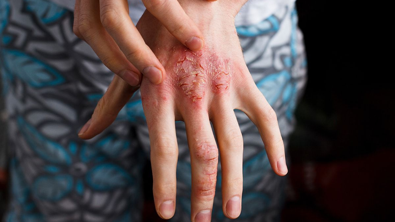 Neuzveicamā cīņa ar atopisko dermatītu